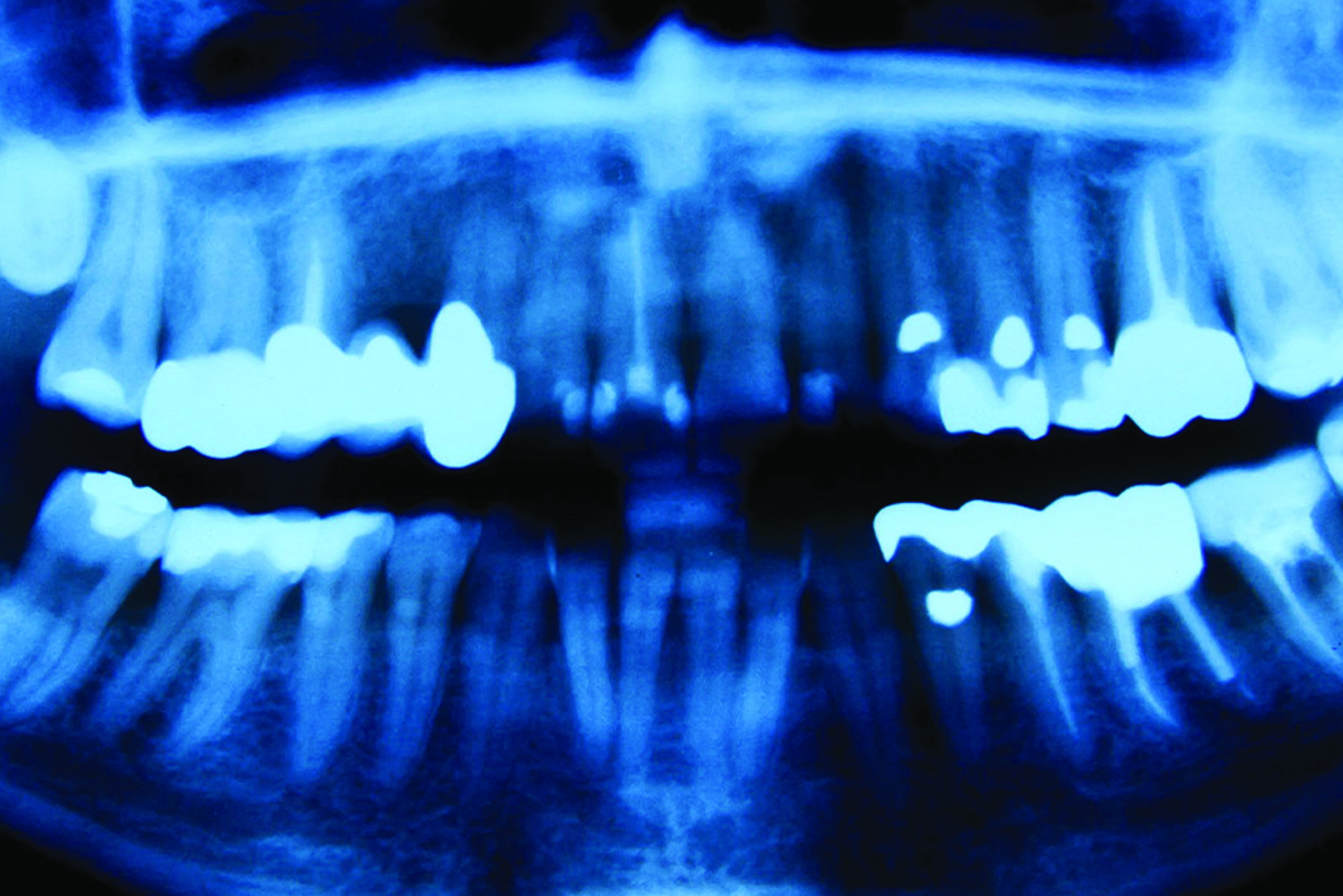 Dental Traumatic Injuries - CXC Dental